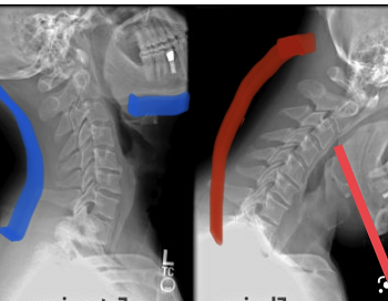 spinal disc treatment