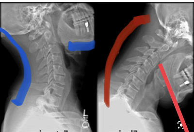 spinal disc treatment